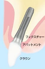 アストラテックインプラント